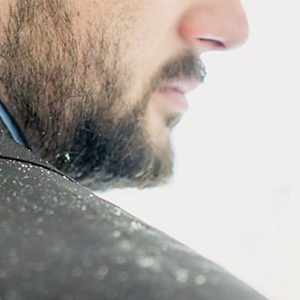 How to Manage Dandruff and Dry Scalp