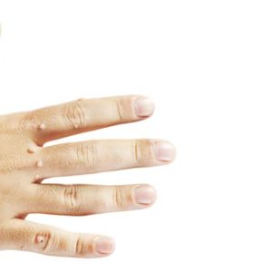 6 Ways to Beat Warts