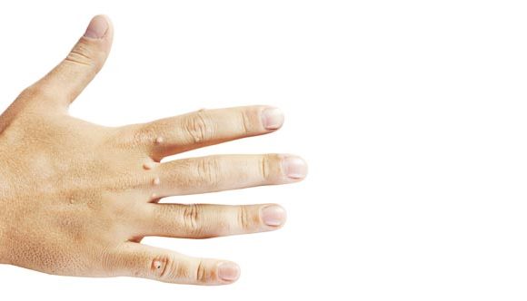 6 Ways to Beat Warts