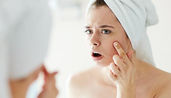 7 Common Culprits that Cause Acne