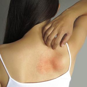 9 Tips To Treat Skin Rashes