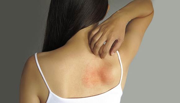 9 Tips To Treat Skin Rashes