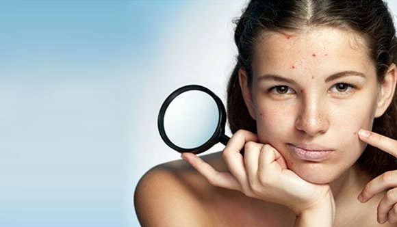 6 Best Ways To Manage Acne