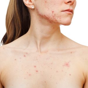 People who can get affected with Acne