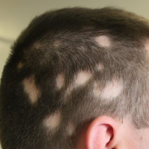 What is Alopecia?