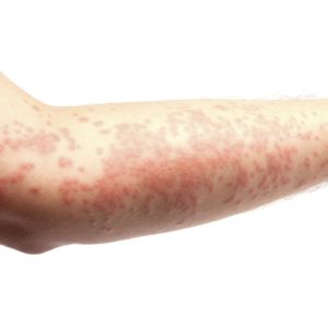 Symptoms of Lichen Planus