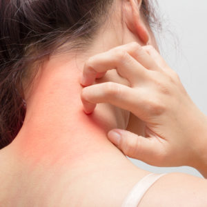 Symptoms of Dermatitis