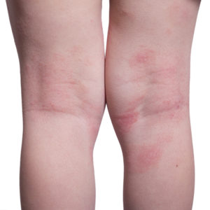 What is Psoriasis?