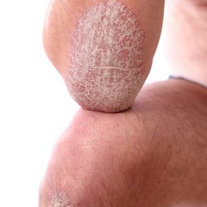 Psoriasis Symptoms