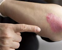 People who may suffer from Psoriasis