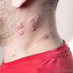 People who suffer from Lichen planus