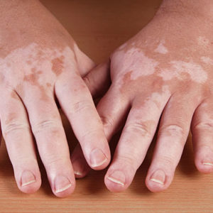 Symptoms of Vitiligo