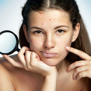 Symptoms of Acne