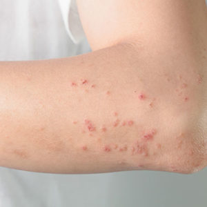 What is Lichen Planus?