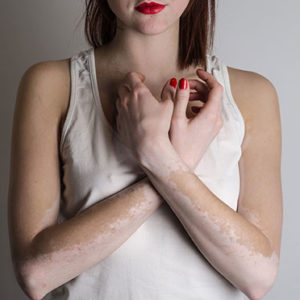 What Is Vitiligo?