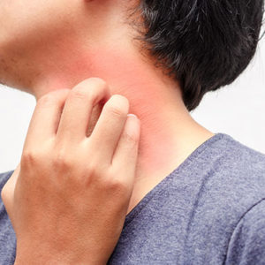 What is Dermatitis?