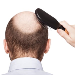 What is male pattern baldness?