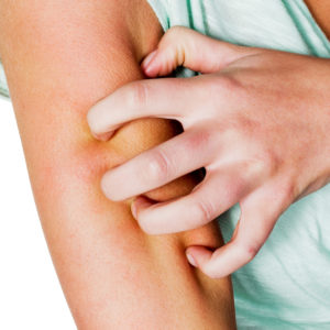 What is Urticaria?