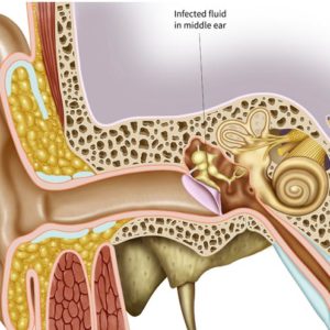 Acute Suppurative Otitis Media (Discharge from ear)