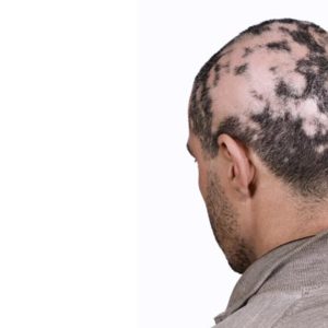 Alopecia Areata (Patchy Hair Loss)