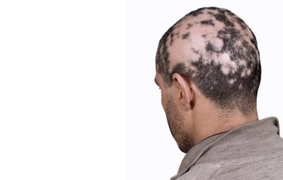 Alopecia Areata (Patchy Hair Loss)