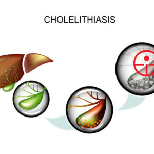 Cholecystitis