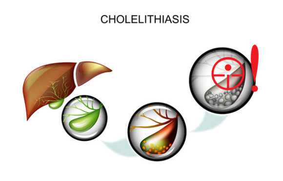 Cholecystitis