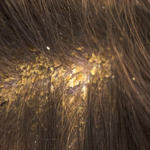 Dandruff / Seborrhoea