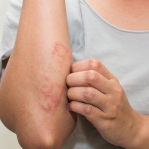 Eczema / Dermatitis