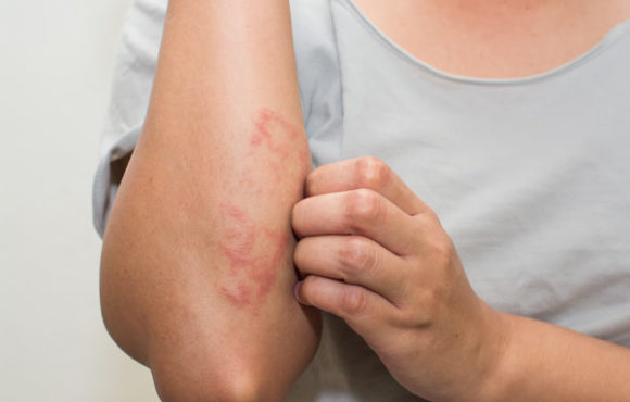 Eczema / Dermatitis