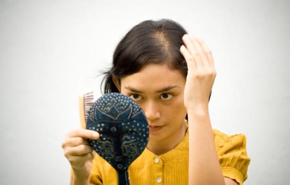 Female Pattern Baldness / Hair Thinning