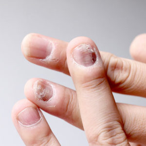 Fungal Infections / Nail Infections