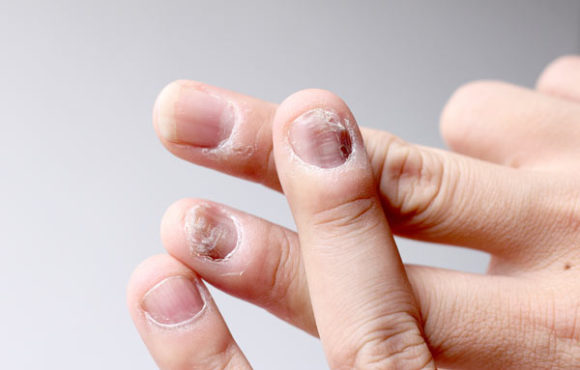 Fungal Infections / Nail Infections