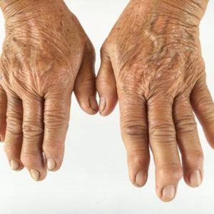 Gout / Arthritis