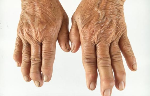 Gout / Arthritis