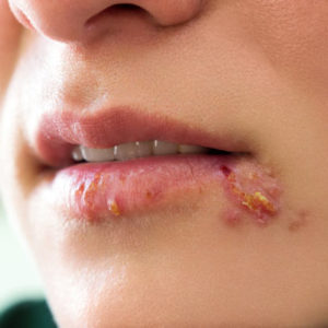 Homeopathic Remedies for Herpes