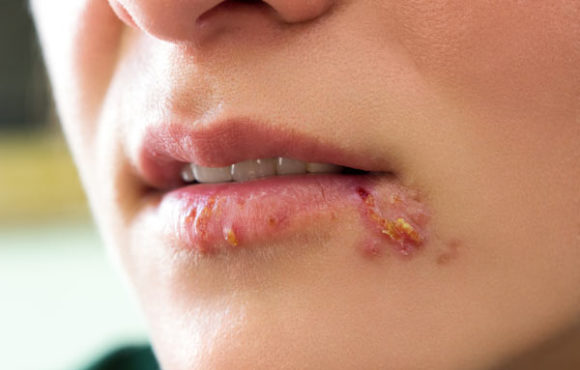 Homeopathic Remedies for Herpes