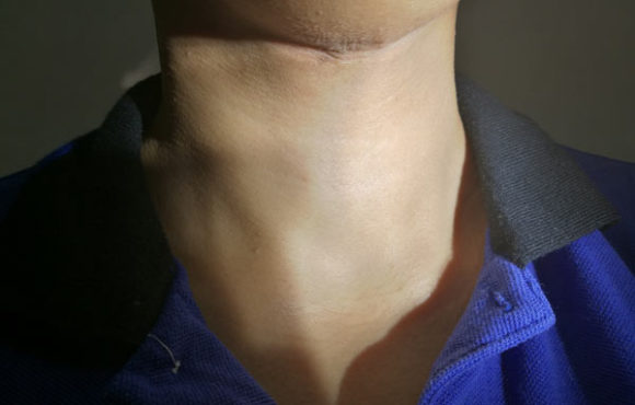 Hyperthyroid