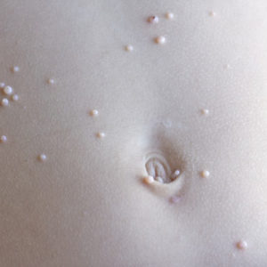 Molluscum Contagiosium