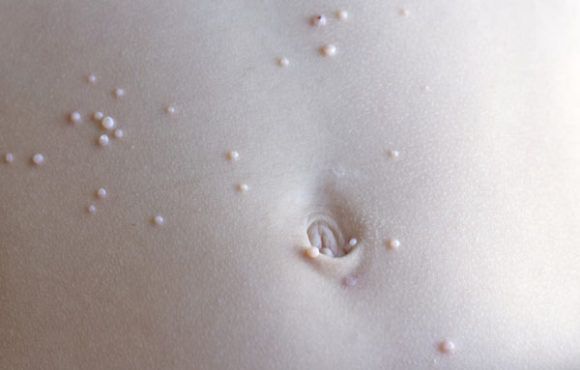 Molluscum Contagiosium