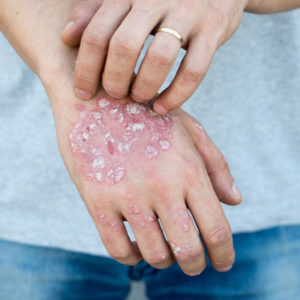 Psoriasis Treatment in Homeopathy