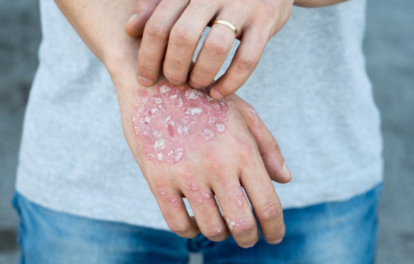 Psoriasis Treatment in Homeopathy