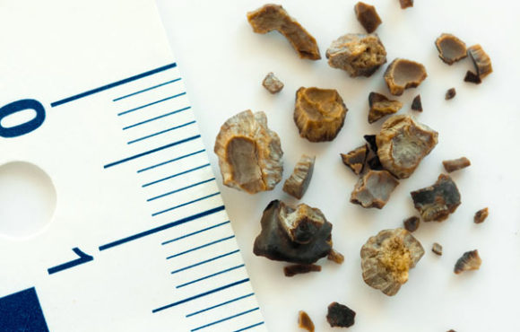 Renal Stones