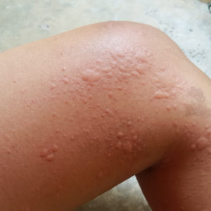 Urticaria (Hives)