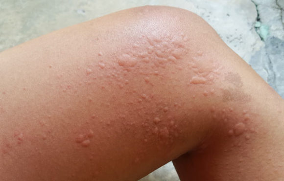 Urticaria (Hives)