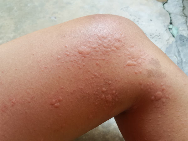 Homeopathic remedies for urticaria