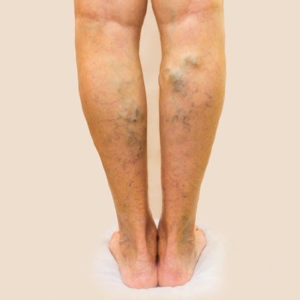 Varicose Veins Treatment in Homeopathy