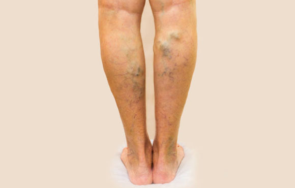 Varicose Veins Treatment in Homeopathy