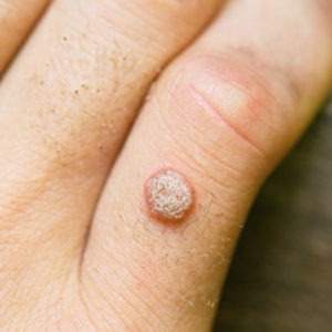 Warts Treatment in Homeopathy