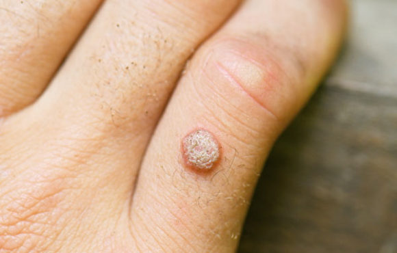 Warts Treatment in Homeopathy